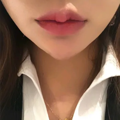 [微整形] 鄭醫師 - 豐唇玻尿酸