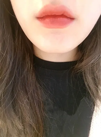 [微整形] Ji Ddol-i - 嘴唇填充、肉毒桿菌