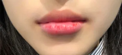 [微整形] 이이ddd - 嘴唇填充