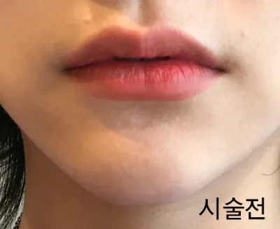 [微整形] 啦啦鈴咚 - 嘴唇填充