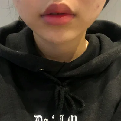 [微整] 懶得打字ㅋ - 嘴唇填充