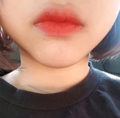 [微整形] awdrgyj - 嘴唇填充、肉毒桿菌