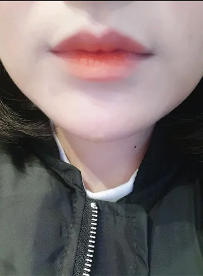 [微整形] kkd0229 - 豐唇填充