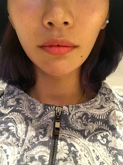 [微整形] 化妝的貓 - 嘴唇填充、肉毒桿菌