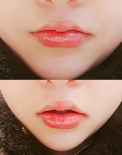 [微整形] 金公主, - 嘴唇填充, 肉毒桿菌