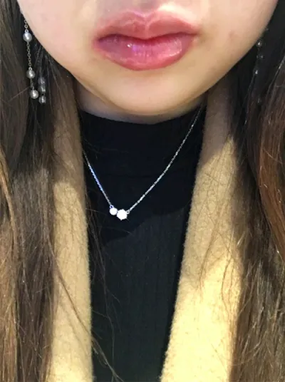 [微整形] 肚子餓了喳喳 - 嘴唇填充、肉毒桿菌