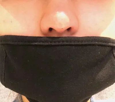 [微整] Momo99 - 鼻雕塑注射