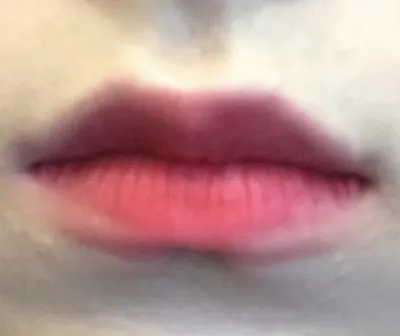 [微整形] 雙眼皮手術成功 - 嘴唇填充