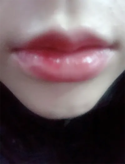 [微整] 330330 - 嘴唇