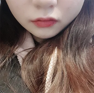 [微整] 張咿呀 - 音波拉提、肉毒桿菌