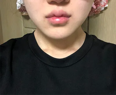 [皮膚] 蹦緊 - 音波拉提