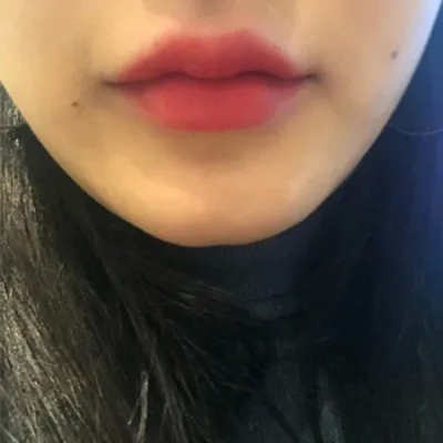 [微整形] hjhsjs - 下巴肉毒、填充