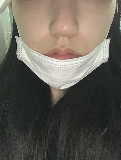 [微整] 햇빛55 - 鼻子