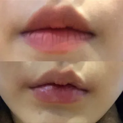 [微整] 찌닝니니 - 唇部
