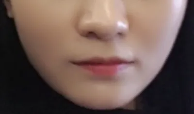 [微整形] 수비니ts - 嘴唇填充