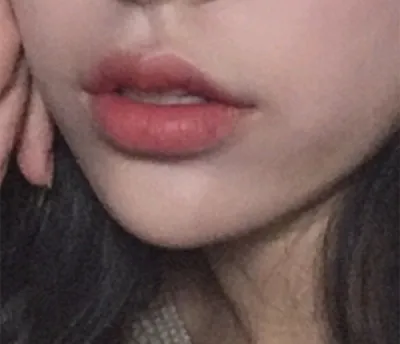 [微整形] 該怎麼說呢 - 嘴唇填充、肉毒桿菌