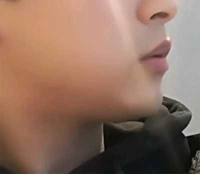 [皮膚] 呵呵呵 - 音波拉提、輪廓肉毒