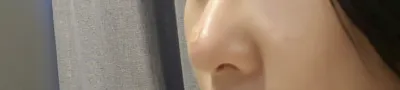 [微整形] 江南 - 鼻子填充