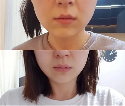 [微整] deinmm - 音波拉提、輪廓肉毒