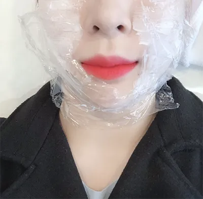 [微整] 1_0A - 音波拉提, 輪廓肉毒