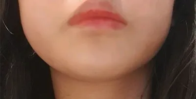 [皮膚] 긔단 - 激光拉提