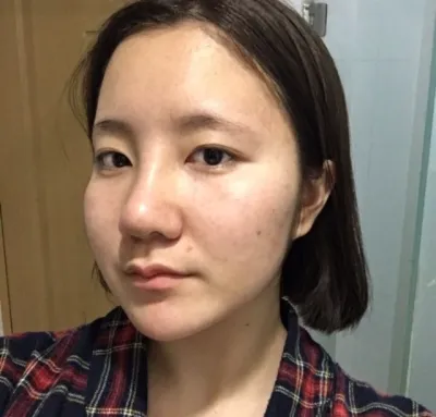 [鼻] 李元德 - 鼻部整形