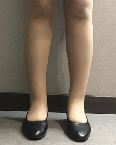 [抽脂] 如星星般閃耀 - 小腿