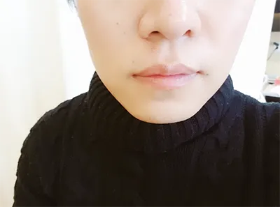 [微整] 潤麗潤麗 - 提拉