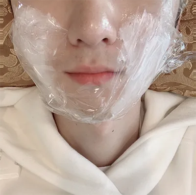 [皮膚] 王栗子紅豆麵包 - 音波拉提(Ultraformer III), 輪廓針