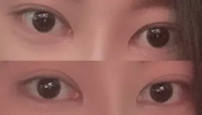 [眼睛] Doo Ts - 眼睛重修手術