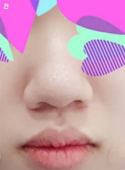 [微整形] Wasabim - 鼻子