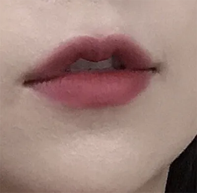 [微整形] amy13 - 豐唇填充