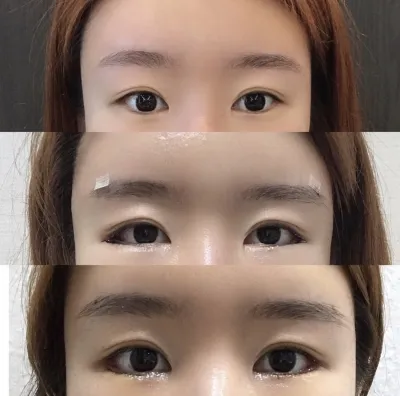 [眼睛] Nana的 - 開後眼角、開下眼角