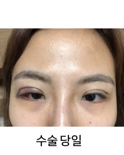 [眼睛] スリ8536 - 眼型矯正