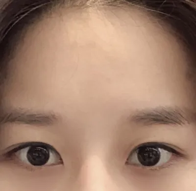 [眼睛] 舜均 - 後眼角切開, 下眼瞼下至