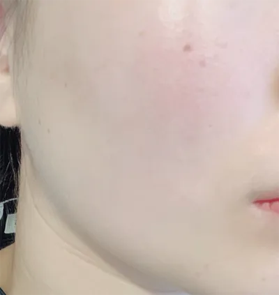 [皮膚] 梭達提可 - 音波拉提