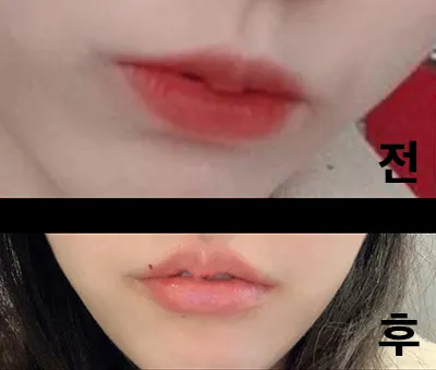 [微整] 嗚哇 - 嘴唇填充