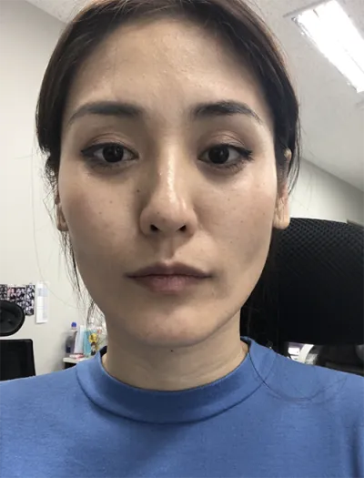 [抗衰老] 娜慕娜 - 全臉脂肪移植