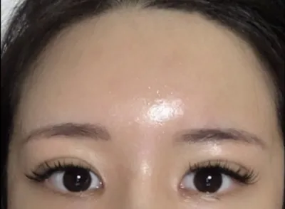 [抗衰老] 好療龍 - 脂肪移植、眼部手術