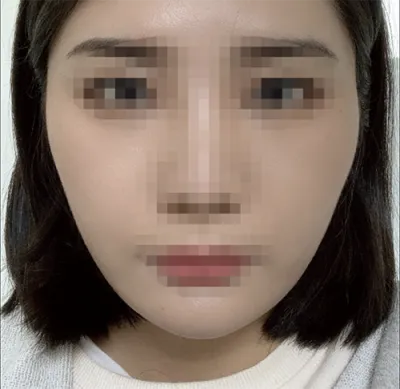 [顏面輪廓] 喔잉잉啊 - 顏面輪廓、鼻子、脂肪移植