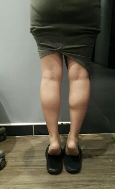 [微整形] 香氣媽媽 - 小腿