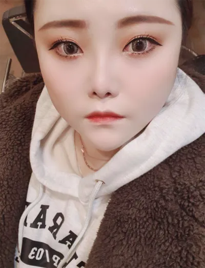 [微整形] lilyheejoo - 嘴唇