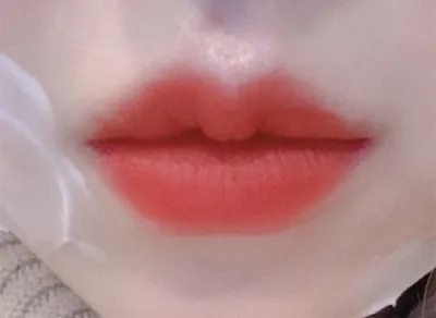 [微整形] hunnie8894 - 嘴唇填充