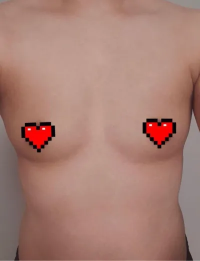 [隆胸] 喔喔耶 - 胸部