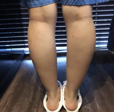 [微整形] 뿅균 - 肉毒桿菌、脂肪分解注射