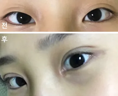 [眼睛] solmdd - 開眼頭、眼型矯正