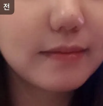 [皮膚] oy1004 - 拉提、水光注射