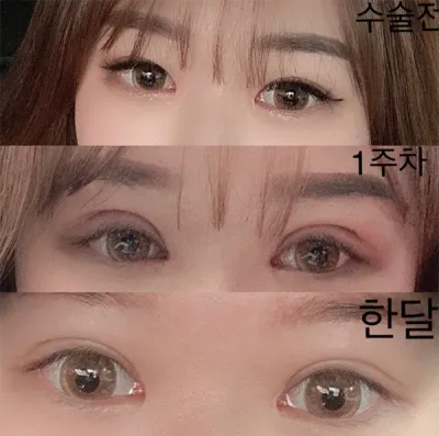 [眼睛] Rosicion - 開上眼角、眼型矯正、重修手術