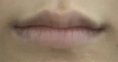 [微整形] 치퀸쓰 - 嘴唇