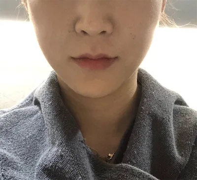 [皮膚] kkkkyu - 音波拉皮